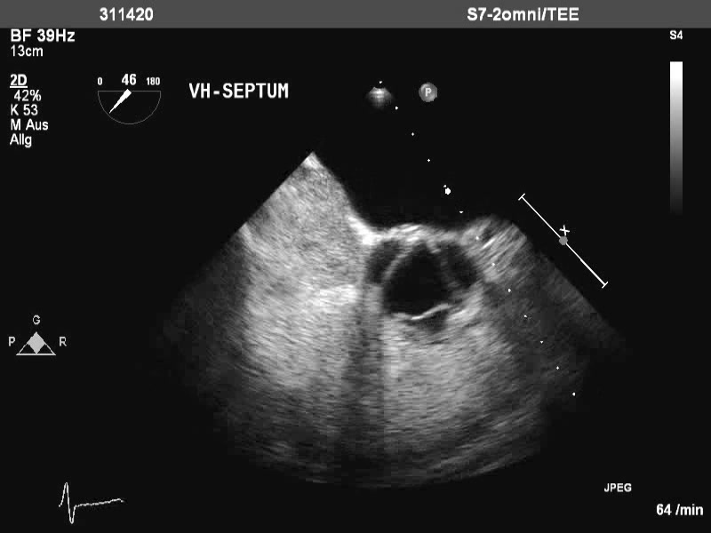 Exakte Darstellung von Trikuspidalklappe, Pulmonalklappe und Aortenklappe im TEE (=Schluckecho)