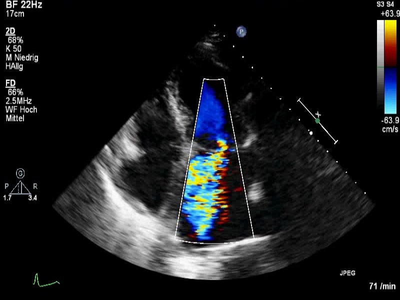 schwere Mitralinsuffizienz